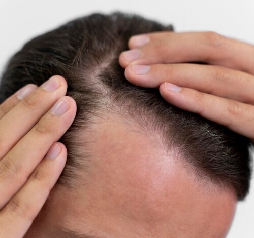 Queda de cabelo no início do ano: saiba causas e tratamentos