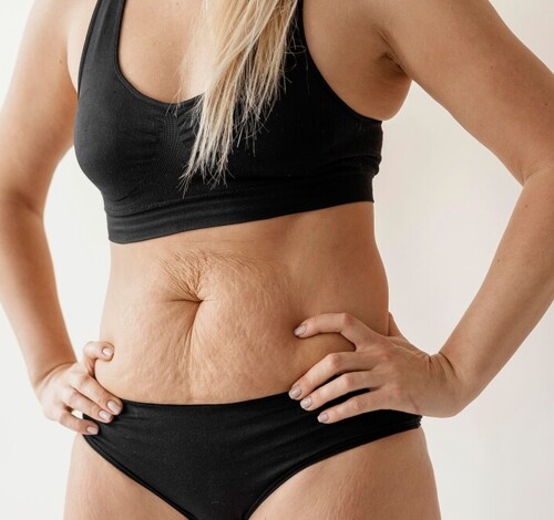 Barriga pós parto? Diástase abdominal vai além da estética e pode exigir tratamento