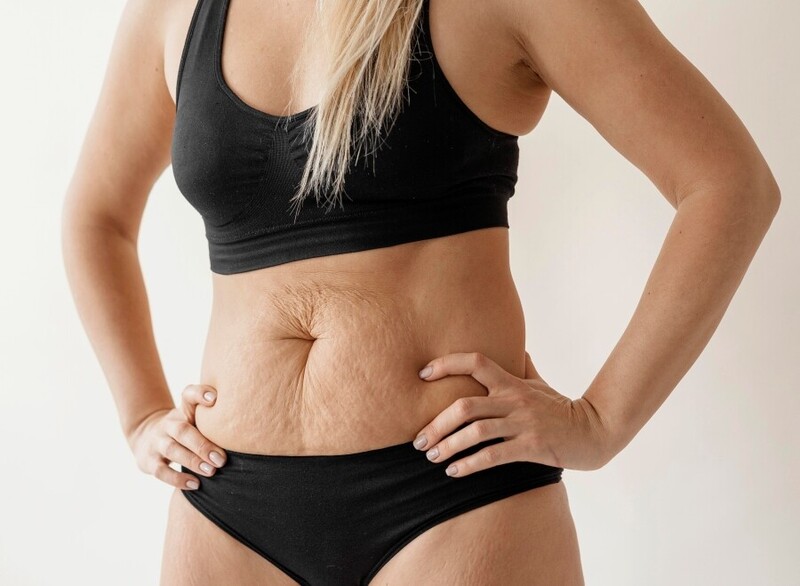 Barriga pós parto? Diástase abdominal vai além da estética e pode exigir tratamento